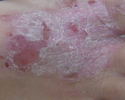 Eczema Treatment